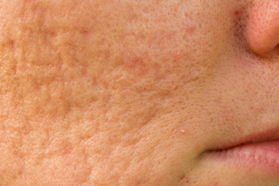 Acne Scarring