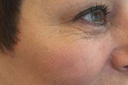 Botox to eyes/crows feet after