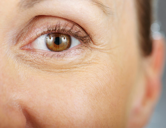 Eye Area Rejuvenation & Tear Trough Devon