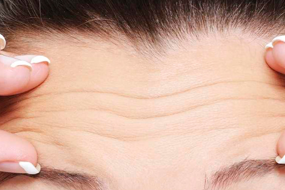 Forehead lines, Wrinkle Treatment Devon, Botox Devon